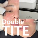 더블스킨 | 청담피부과 고주파시술 모공레이저 더블타이트 스킨부스터 솔직 후기!