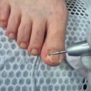 동성프라자 | 무좀발톱, 무좀 발톱 때문에 스트레스받는 분들이라면 '본네일 동성제약 풀리메디 문제성 발관리'