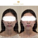 7554 | 청담 신부관리 보나트페이스 안면윤곽 수기관리 솔직 후기