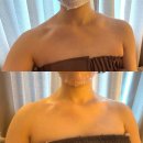 참좋은 통증의학과의원 | 출산 산후관리 어깨 승모근 파셀라리프팅 내돈내산 후기