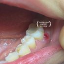 덕화약국 | [치료후기] 1탄, 잇몸 고름주머니, 빨리 치과가세요! : 임플란트 할 뻔했던 찐후기...
