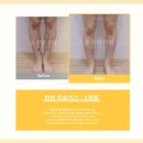 모세혈관염 원인부터 증상, 치료까지 총정리합니다. -17년 경력 대표원장 작성