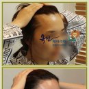 연헤어라인 네이버블로그