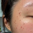 강남동일한의원 | [강남] 큐어람한의원 편평사마귀 제거 일주일 경과 리터치 후기