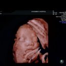 w-28 | 인천 w여성병원 28주 입체 초음파 후기 (베이비페이스 무료, 선택 제왕 예약)