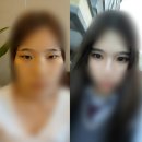 ♥눈매교정,앞트임 1달차 후기♥ 이미지