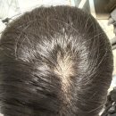 영양-2)영양군 제일안경원 앞 | 여성 탈모 원인의 대부분은 영양 불균형, 부족! 탈모 영양제 후기