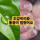 세계일등식품 | 조갑박리증 손톱 발톱 조갑분리증 염증 통증에 좋은 음식 건강 식품 영양제