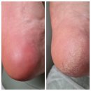 오니크네일 | 우장산역 발각질케어는 오니크네일디에고푸스화곡점