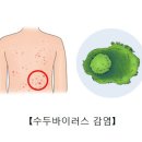 수두 Varicella (chickenpox) 이미지