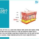 두드림의 MACS 리프팅으로 동안효과 기대할 수 있어? 이미지