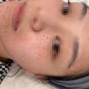[리쥬란후기] 내돈내산 리쥬란 1회차 우유빛의원 추천 손주사 환공포리쥬란 후기 / 주의사항 / 속건조 개선