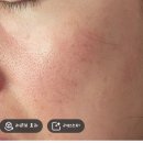 문경한의원 | 안면홍조와 만성염증의 원인 자율신경실조증 치료 후기 3탄