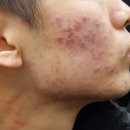 고려한의원 | 피부과한의원 흉터 유형 맞게 맞춤 시술 후기