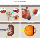 고혈압의 합병증 이미지