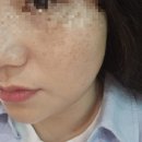 [남악 피부관리]단미뷰티 후기, 잡티레이저 효과 + 가격정보 총정리 (목포·남악 에스테틱)