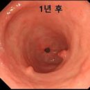 대장 용종 선종성 비선종성 용종 원인과 예방 관리법 이미지