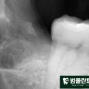 범플란트치과의원 네이버블로그