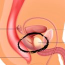 PSA (Prostate-Specific Antigen) 수치 상승의 원인과 접립선암과의 관계 이미지