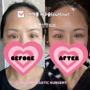 두한성형외과의원 | 잘못된 쌍꺼풀 수술, 재수술로 해결할 수 있을까요?