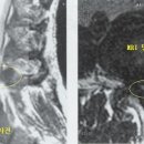 척추관협착증-spinal stenosis 이미지