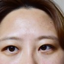 조미경헤어 | 에스앤유 조미경 피부과에서 꺼진 이마 주름과 작별하기!