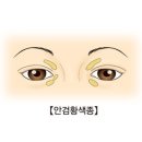 안검황색종Xanthelasma피부질환 이미지