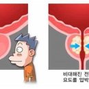 전립선 비대증에 대하여 이미지