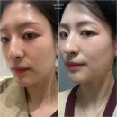 유명한 스킨 | 신논현 스킨부스터 유명한 피부과 쥬브아셀 후기!