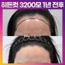 [40대 여자 넓은 이마 헤어라인 머리심기] 비절개 히든컷 모발이식 3200모 1년 후기 (모엠의원/헤어라인/전지훈원장) 이미지