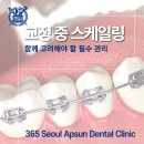 도화본365의원 | 도화역치과 교정 중 스케일링, 교정치료와 함께 고려해야 할 필수 관리