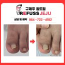 레푸스제주 | [제주내성발톱] 무좀발톱&내성발톱 셀프케어 하시다 레푸스제주 방문하신 후기