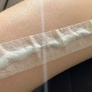 고대의원 | 문신제거 1차 후기 | 인천 구월동 공장형 의원에서 문신제거하기
