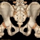 바이크 상관없지만 너무 답답해서 이렇게 올립니다 엉덩이 뼈 골절 수술에 대한것입니다 이미지