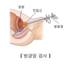 방광암 (Bladder cancer) 이미지