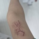 내돈내산 타투제거 강남 문신제거 진담성형외과 2일차까지 후기