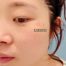 레이저 | 대구 흑자제거 리팟레이저 내돈내산 후기