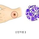 탄저균 탄저병 전염 인수 공통감염병 법정감염병 이미지