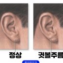 귓볼대각선주름 치매 전조증상 귀 뇌졸중 뇌졸증 귓볼 이미지