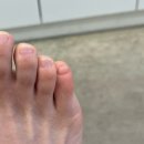 클린풋 | 새끼발톱 두개로 갈라짐 고민 해결 대구 문제성 발관리 전문 독일식 발톱 스케일링 클린풋네일 후기