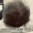 미주3차 | 청량리탈모커버 뉴데이에서 남자 두피 숱채움 3차까지 하고 온 후기