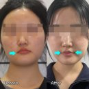 반듯한 이(e)치과교정과치과의원 | 안면비대칭 교정은 하고 싶은데, 양악 수술부작용은 싫어요! 방법이 없을까요?