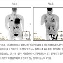 E.T(동맥내 항암치료)란 ? 이미지