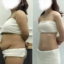 요동환경 | 마운자로 가격 부작용 비교 후기 (10kg 감량)