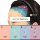 Dr.원흉부외과의원 | 뒷머리가 가늘어도 풍성해지는 모발이식 | 참닥터의원