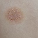 서울푸른봄의원 | 241216(월)(평택) 60개월 피부 곰팡이균 동전습진-(평택)서울푸른봄의원