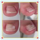 레푸스 | 내성발톱 때문에 고민이라면 꼭 보세요 (천안 레푸스두정점 솔직후기)