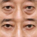 하안검 + 상안검 눈매 변화, 중년 남성 눈밑 경과후기 (신사역 무드온성형외과)