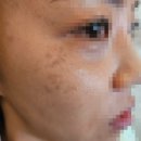 덕소성외과의원 | 압구정 라움성형외과 오타모반 1-4차 치료완료 종합편