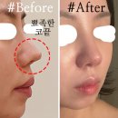 (자가진피코성형) 뾰족한 코끝의 콤플렉스로 코재수술